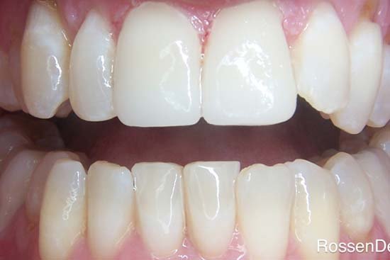 6406089ec0026f44fada301a_welleby-family-dental-general-dentistry-after4-1 6406089ec0026f44fada301a_welleby-family-dental-general-dentistry-after4-1