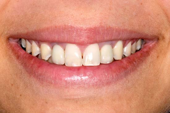 6406089ec0026f4f4cda300c_welleby-family-dental-general-dentistry-after3 6406089ec0026f4f4cda300c_welleby-family-dental-general-dentistry-after3