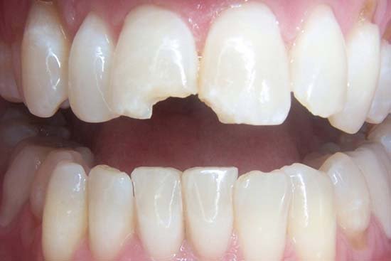 6406089ec0026f594dda301b_welleby-family-dental-general-dentistry-before4-1 6406089ec0026f594dda301b_welleby-family-dental-general-dentistry-before4-1