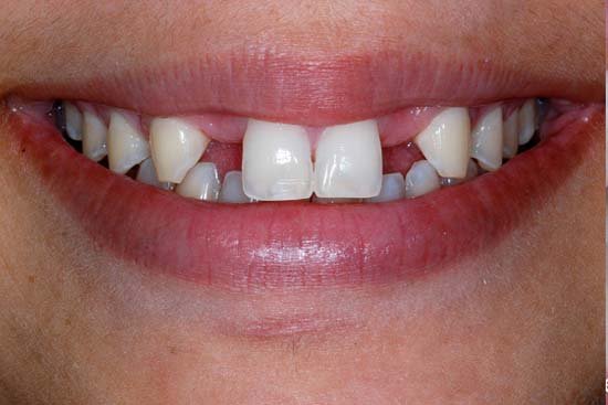 6406089ec0026f90c3da300e_welleby-family-dental-general-dentistry-before3 6406089ec0026f90c3da300e_welleby-family-dental-general-dentistry-before3
