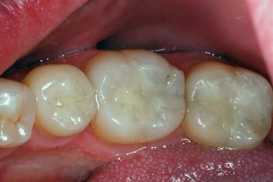 Fillings & Repairs AFTER