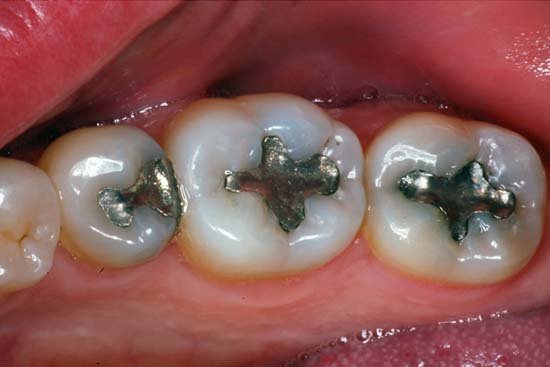 Fillings & Repairs BEFORE