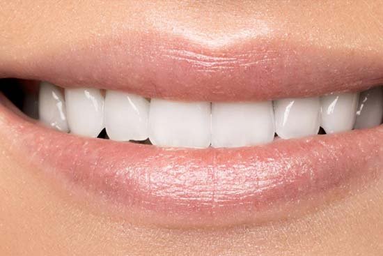 Teeth Whitening AFTER