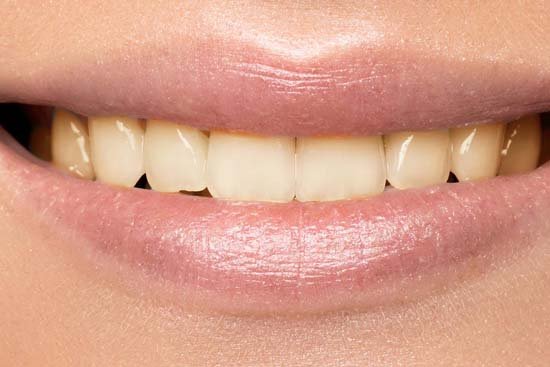 Teeth Whitening BEFORE